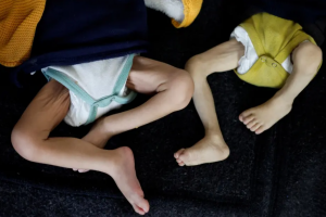 Starvation in Gaza: Emaciated Child Highlights Toll of Israel’s Blockade