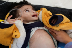 UN Agency Warns Over 50,000 Palestinian Children in Gaza Suffering from Acute Malnutrition