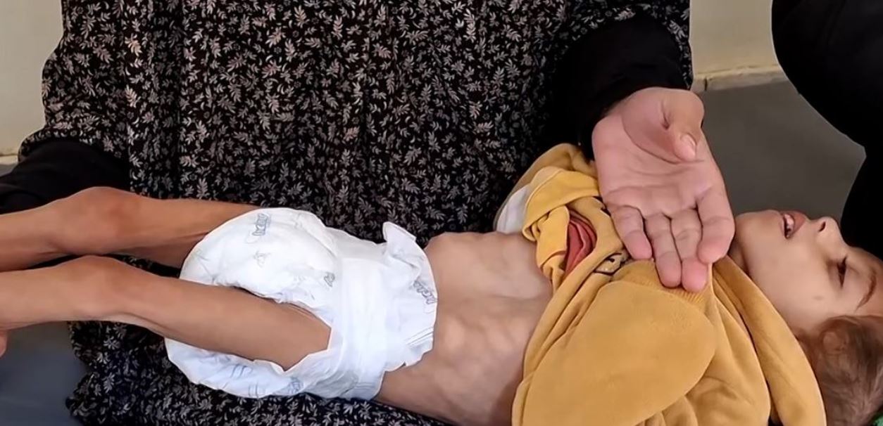 Palestinian Infant Suffers Severe Malnutrition amid Israeli Blockade on Gaza