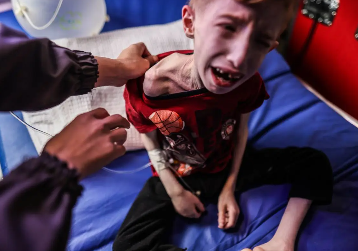 UN: Alarming Surge in Child Malnutrition and Widespread Hunger in Gaza