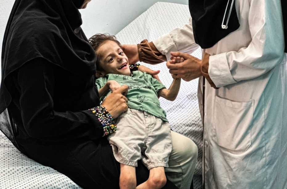 Over 65,000 Gaza Children Hospitalized for Severe Malnutrition amid Ongoing Israeli Blockade