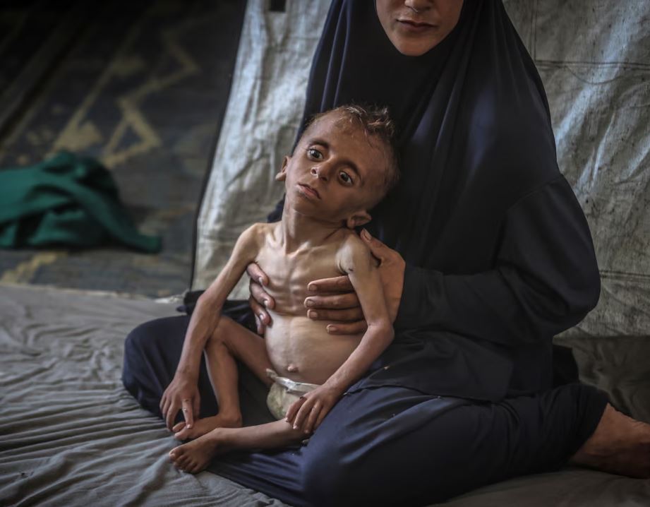 Malnutrition Deaths Mark ‘Latest in War on children’ in Gaza: UN